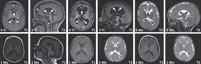 Imagerie par résonance magnétique (IRM) du cerveau de trois enfants présentant une copie manquante du gène Chaserr. 