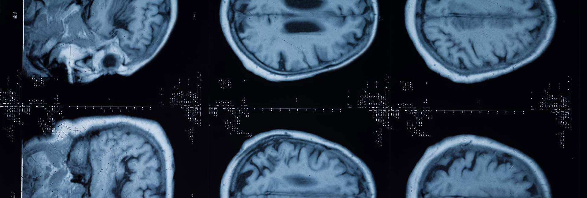 Des mutations de l'ADN non codant protègent le cerveau contre la SLA