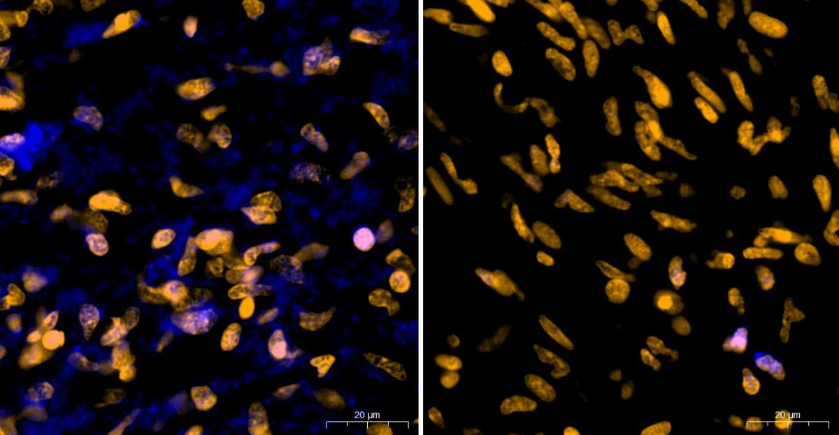 Tissus tumoral glioblastome prélevé sur un patient et immédiatement incubé dans une solution contenant un acide aminé consommé uniquement par les bactéries. 