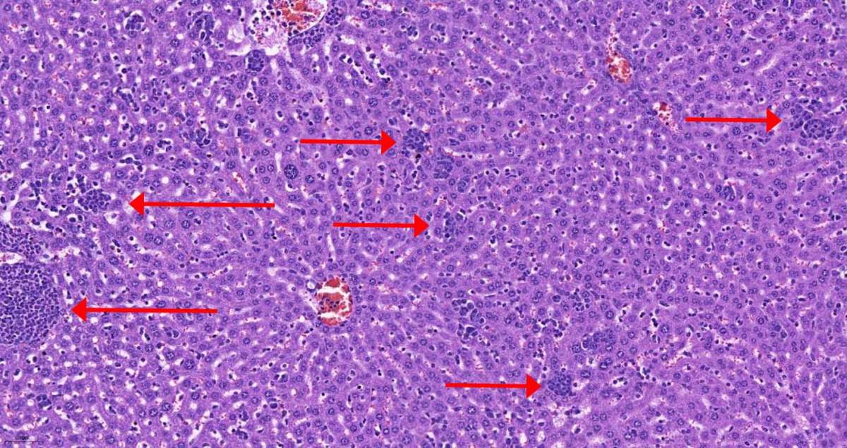 Tissu hépatique d'une souris femelle atteinte d'un cancer du sein. Les cellules du système immunitaire (amas de cellules sombres, marquées par des flèches) pénètrent dans le foie dès les premiers jours de l'apparition de la tumeur.
