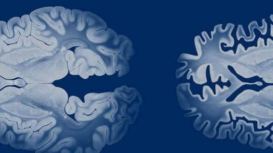 Du cancer à la maladie d'Alzheimer : des cellules immunitaires modifiées réduisent les plaques dans le cerveau