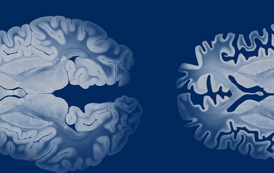 Du cancer à la maladie d'Alzheimer : des cellules immunitaires modifiées réduisent les plaques dans le cerveau