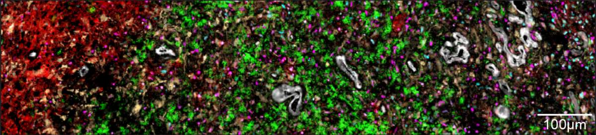 Les couches des tumeurs du glioblastome