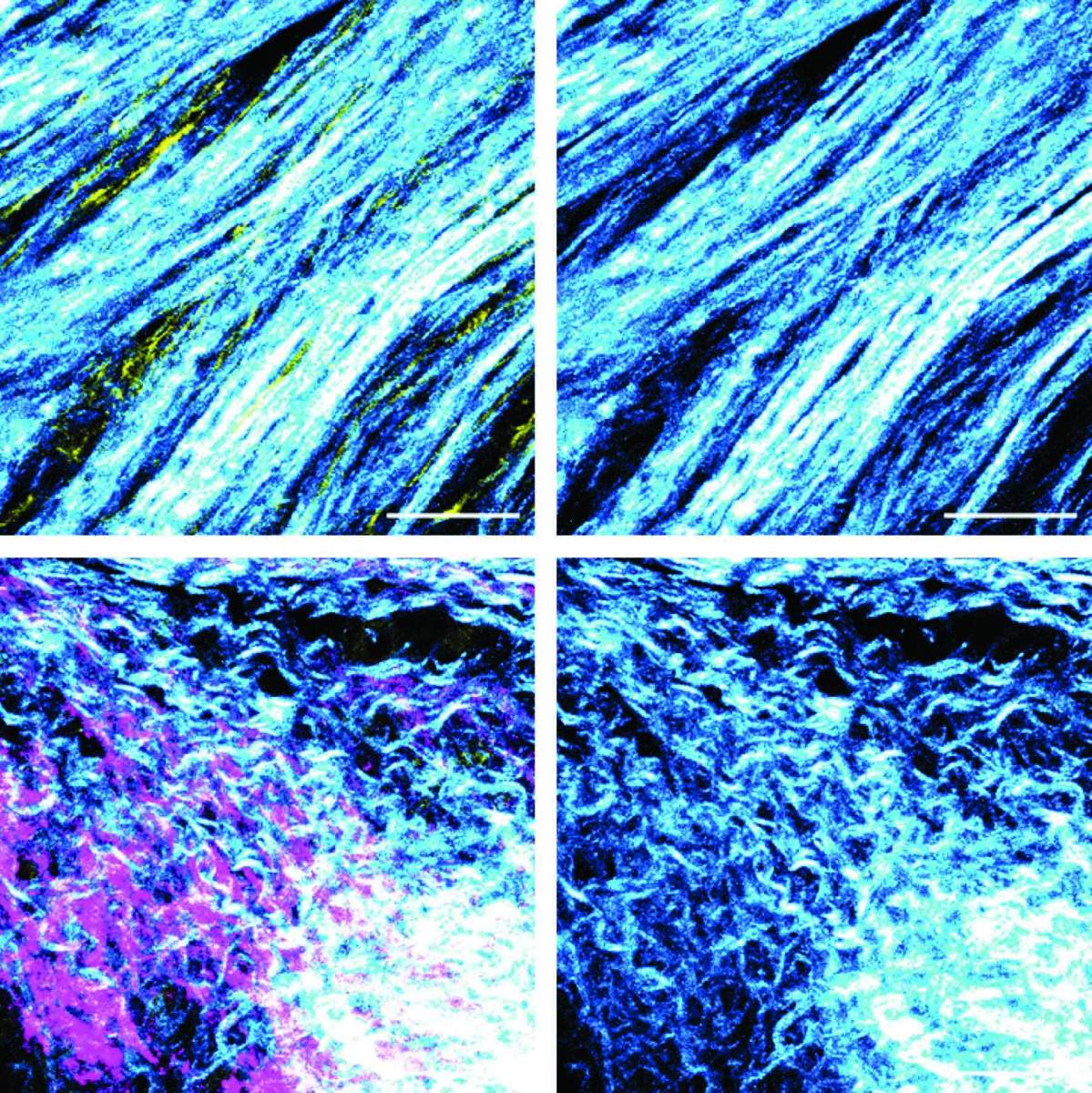 Fibres de collagène déposées par les fibroblastes dans le microenvironnement tumoral, vues au microscope