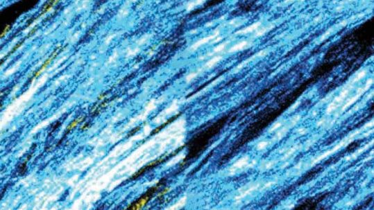 Fibres de collagène déposées par les fibroblastes dans le microenvironnement tumoral, vues au microscope
