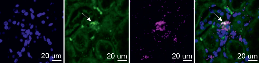 Tissu rénal d'une personne décédée par inhalation de fumée (intoxication au monoxyde de carbone), examiné au microscope. 