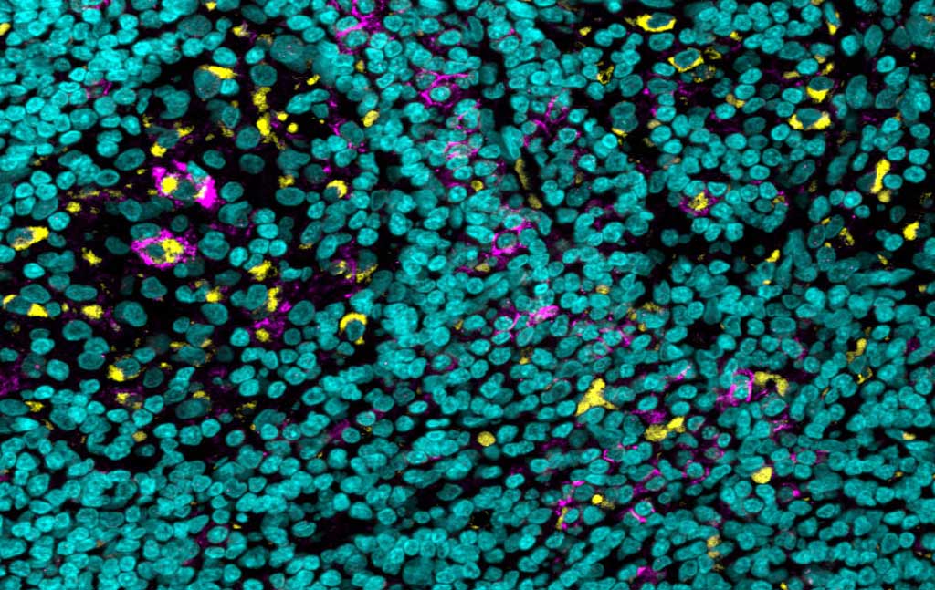 Un échantillon de tissu d'un cancer de la peau particulièrement agressif révèle des cellules immunitaires (en jaune) qui expriment à leur surface un récepteur de "pédale de frein" appelé FcgIIb (en violet) ; les noyaux cellulaires sont en bleu.