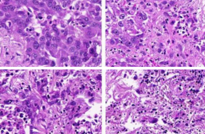 Une nouvelle approche pour adapter la thérapie contre le cancer : exploiter les signaux des cellules cancéreuses