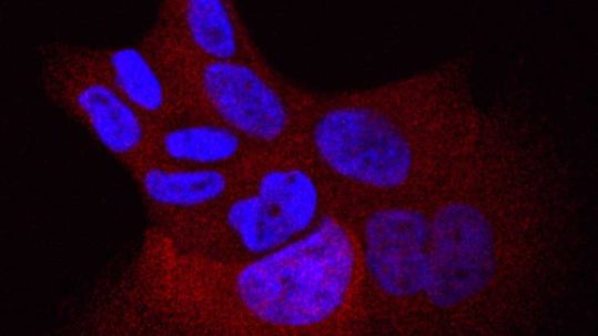 Une étude pourrait apporter une meilleure thérapie à des patients préidentifiés atteints de cancer du poumon