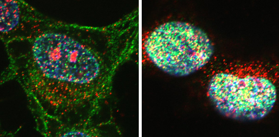 Cellules cancéreuses HeLa, avant et après un traitement aux stéroïdes