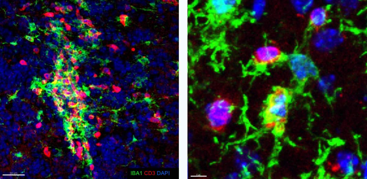 Le cerveau d'une souris atteinte d'une maladie semblable à la SEP révèle des groupes de microglies (en vert) et de cellules T (en rouge). À gauche : vue générale ; à droite : zoom avant