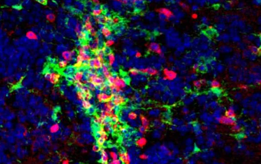 Le cerveau d'une souris atteinte d'une maladie semblable à la SEP révèle des groupes de microglies (en vert) et de cellules T (en rouge). À gauche : vue générale ; à droite : zoom avant